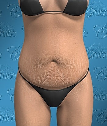 Close-up of abdomen featuring stretch marks.