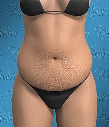 Model displaying stretch marks in swimwear.
