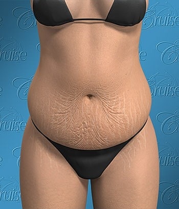 Woman with stretch marks in bikini.