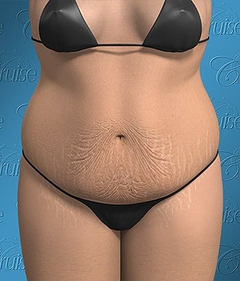 Body model showing stretch marks and bikini.