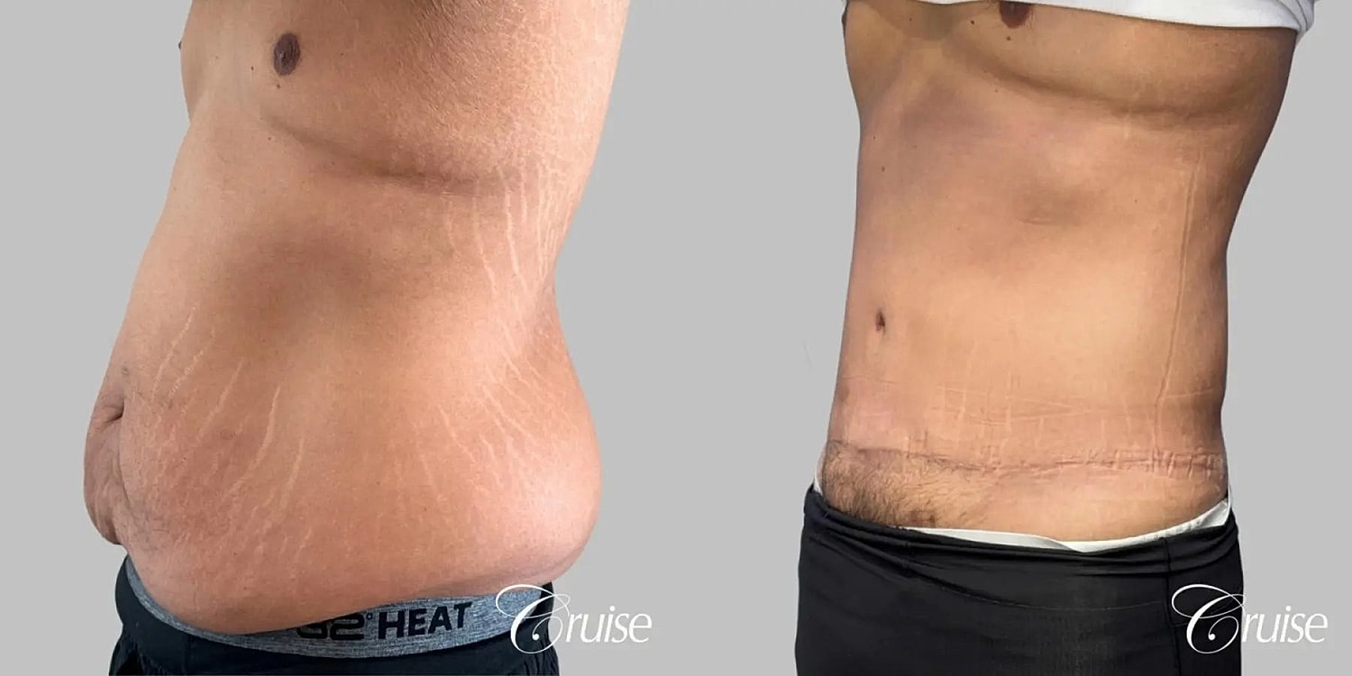 Tummy Tuck Before & After
