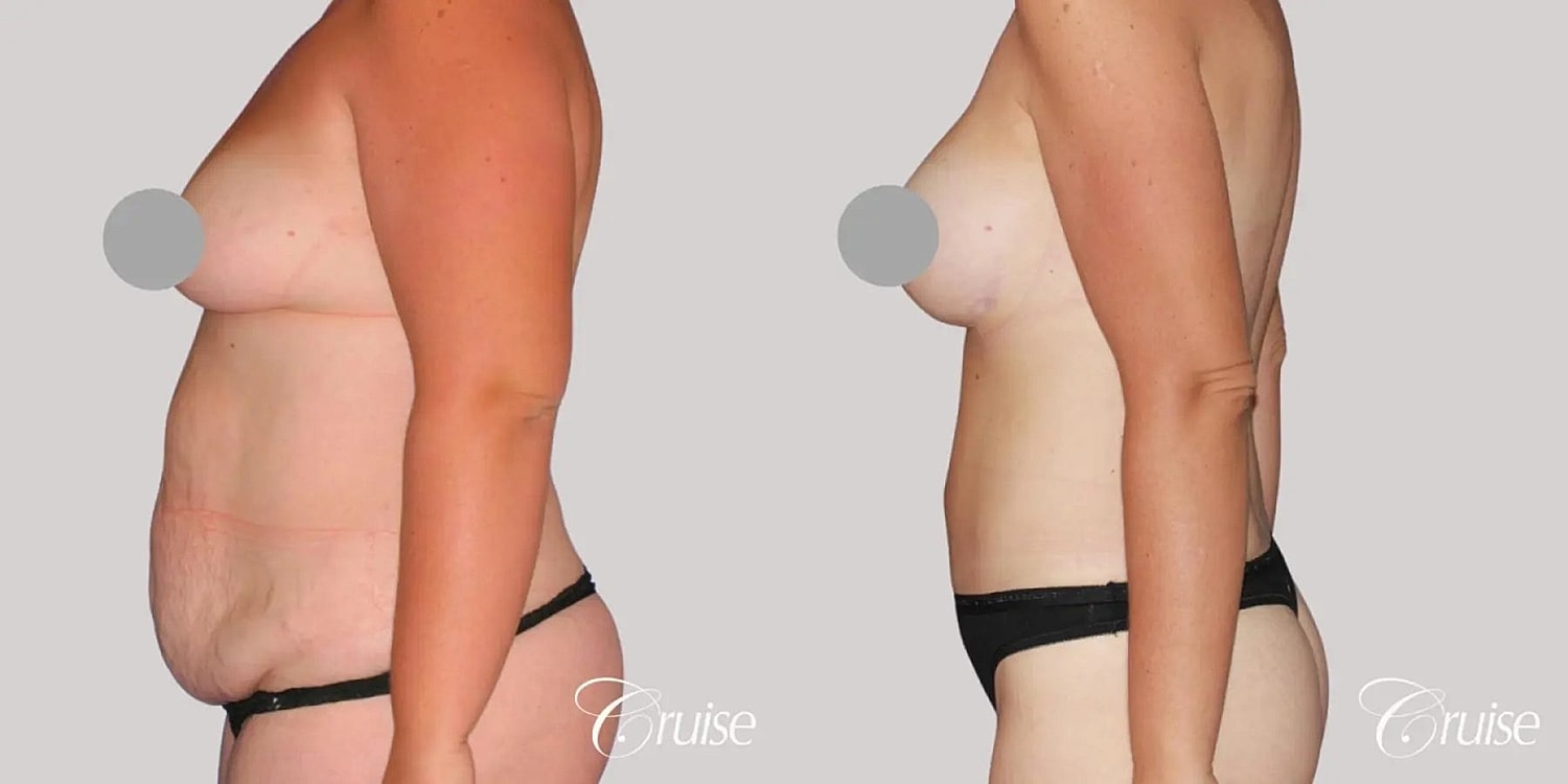 Tummy Tuck Before & After