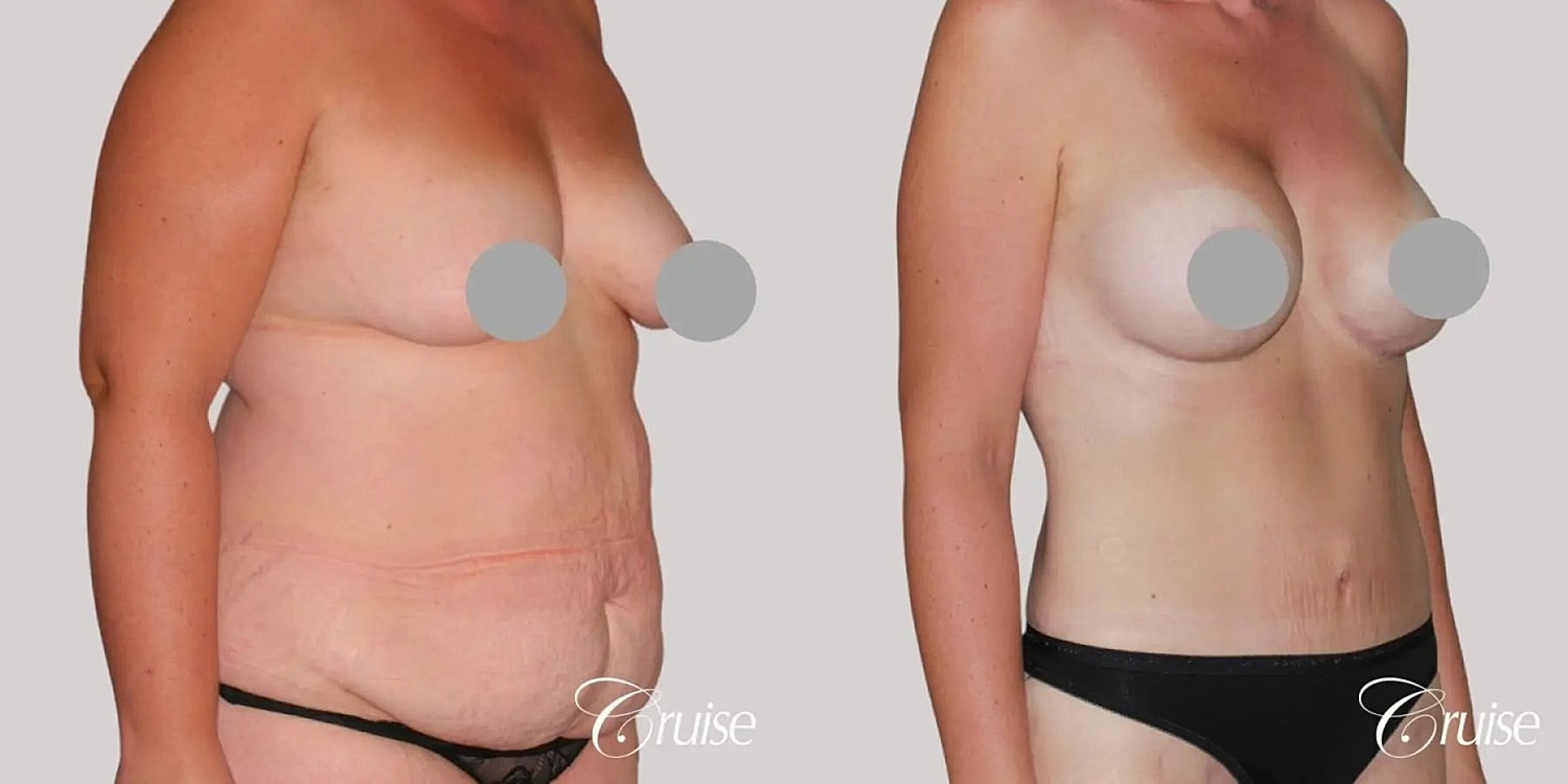 Tummy Tuck Before & After