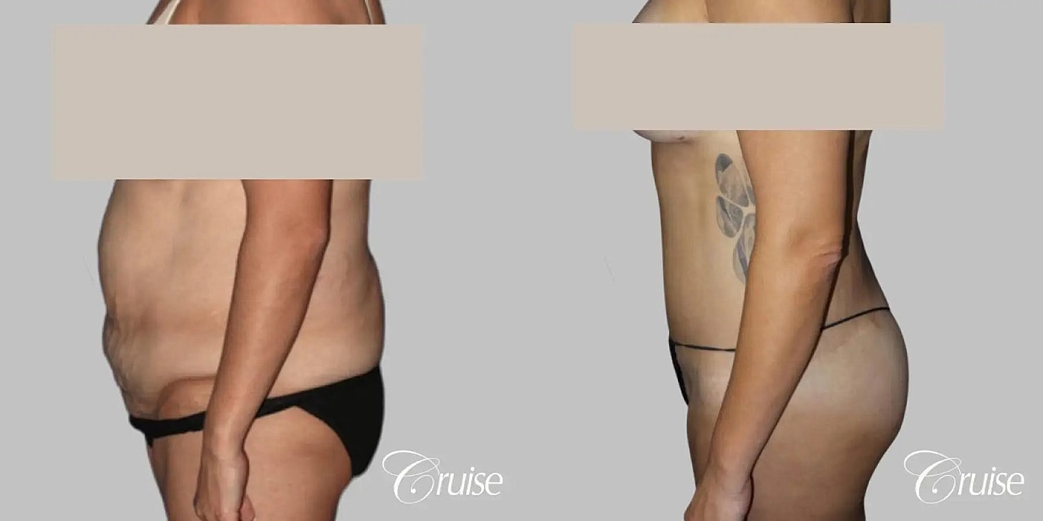 Tummy Tuck Before & After