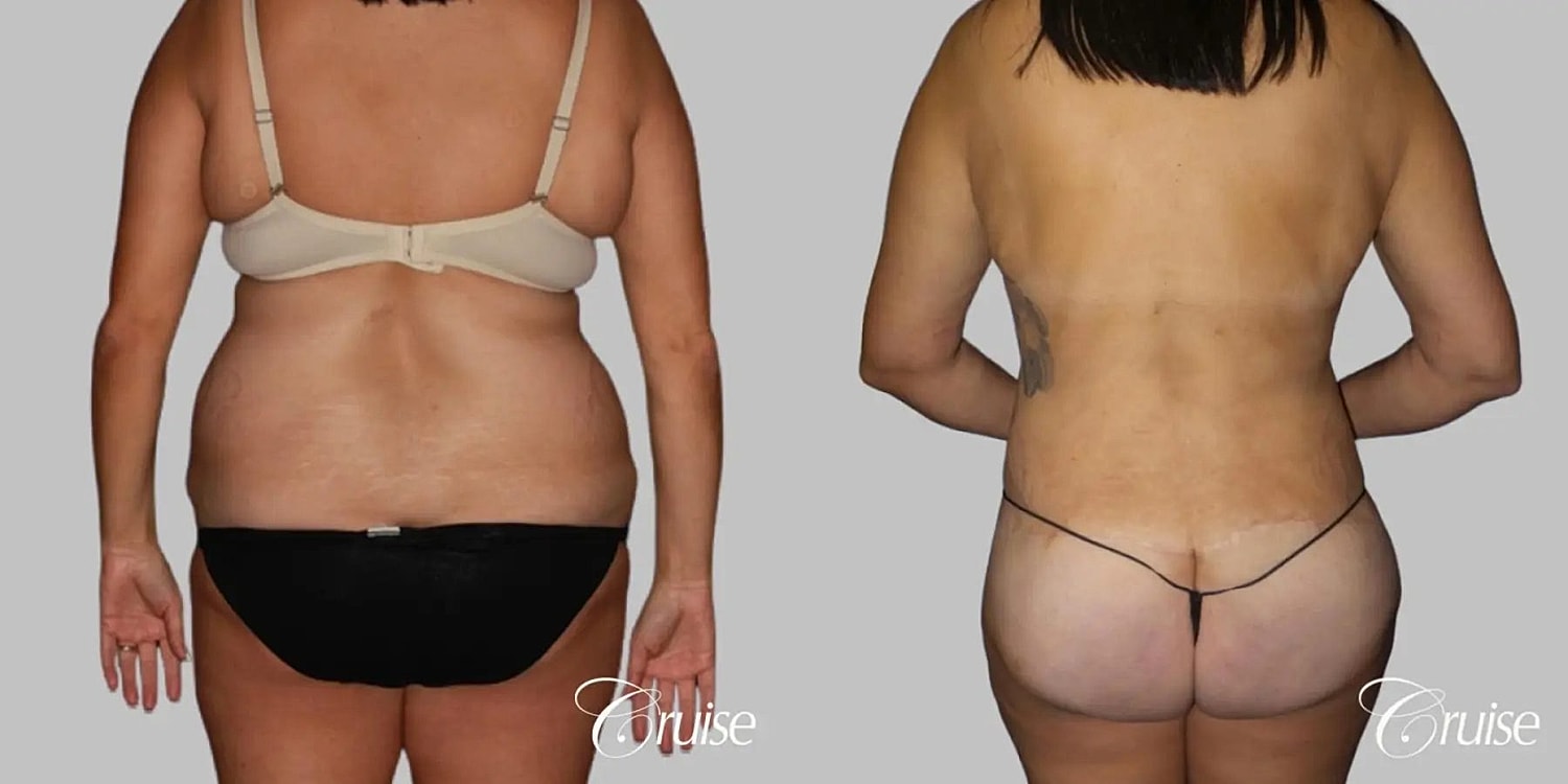 Tummy Tuck Before & After