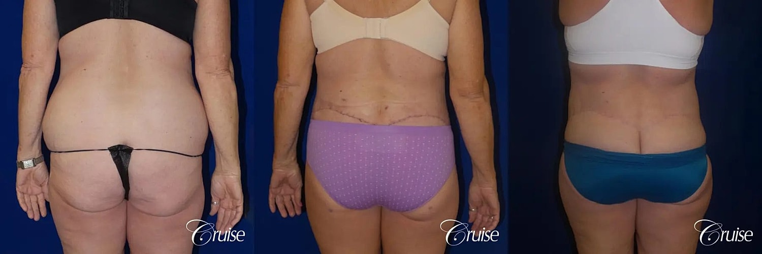 Tummy Tuck Before & After
