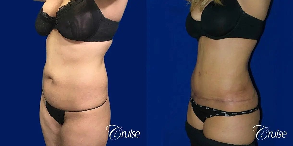 Tummy Tuck Before & After