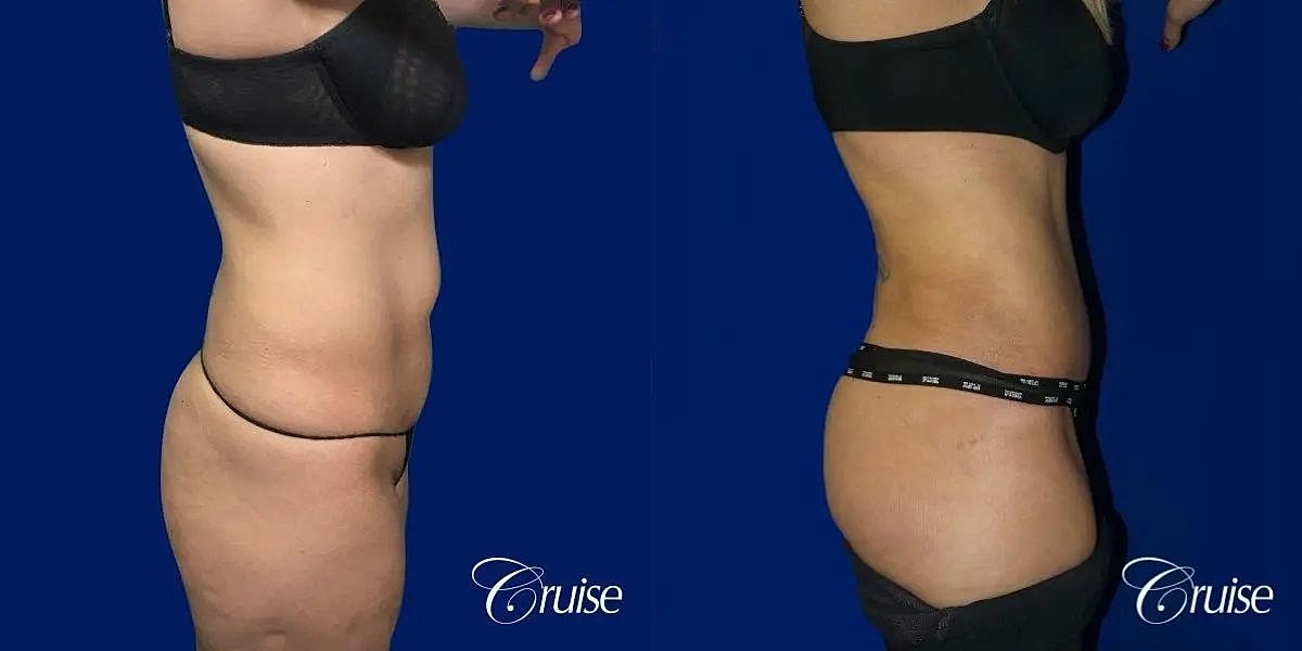 Tummy Tuck Before & After