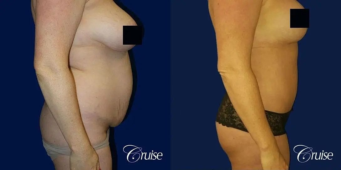 Tummy Tuck Before & After