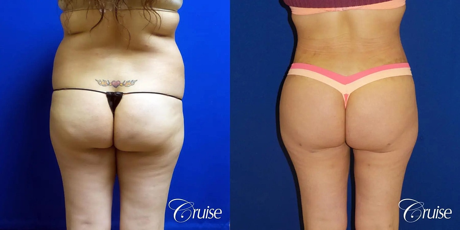 Tummy Tuck Before & After