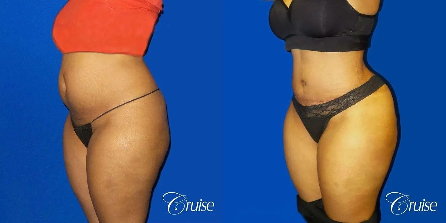 Tummy Tuck Before & After