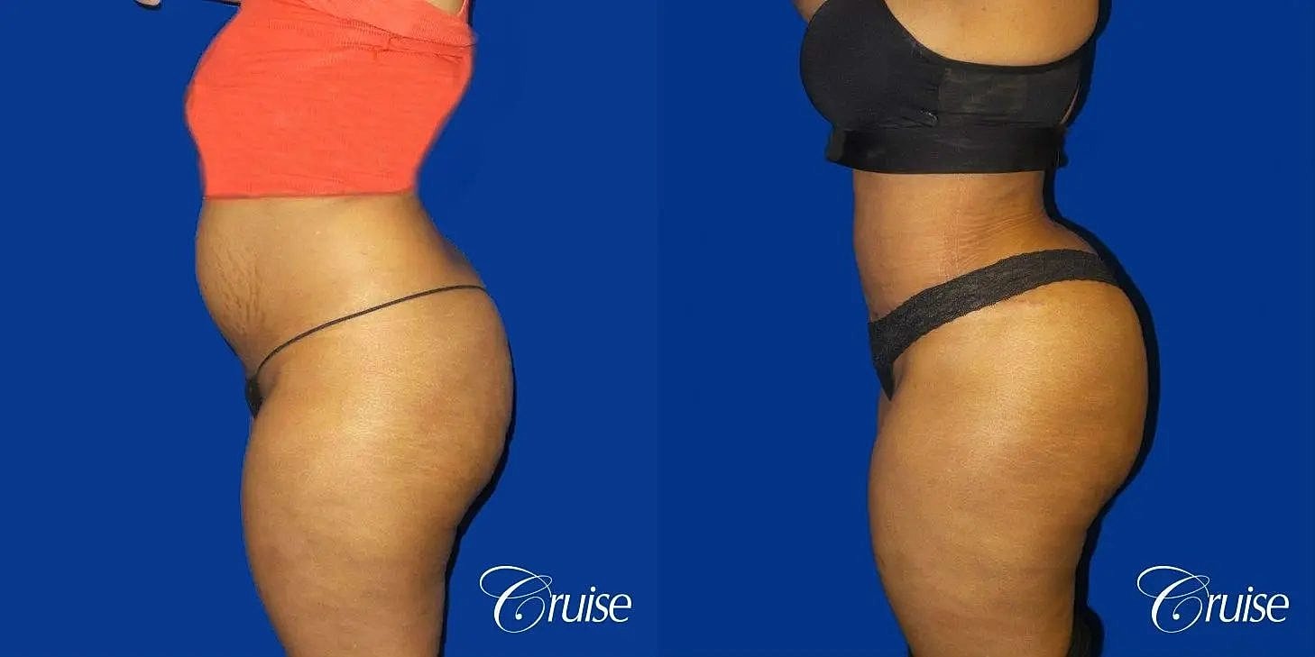 Tummy Tuck Before & After
