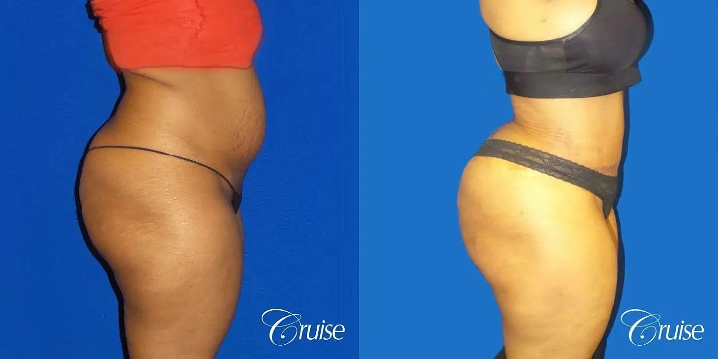 Tummy Tuck Before & After