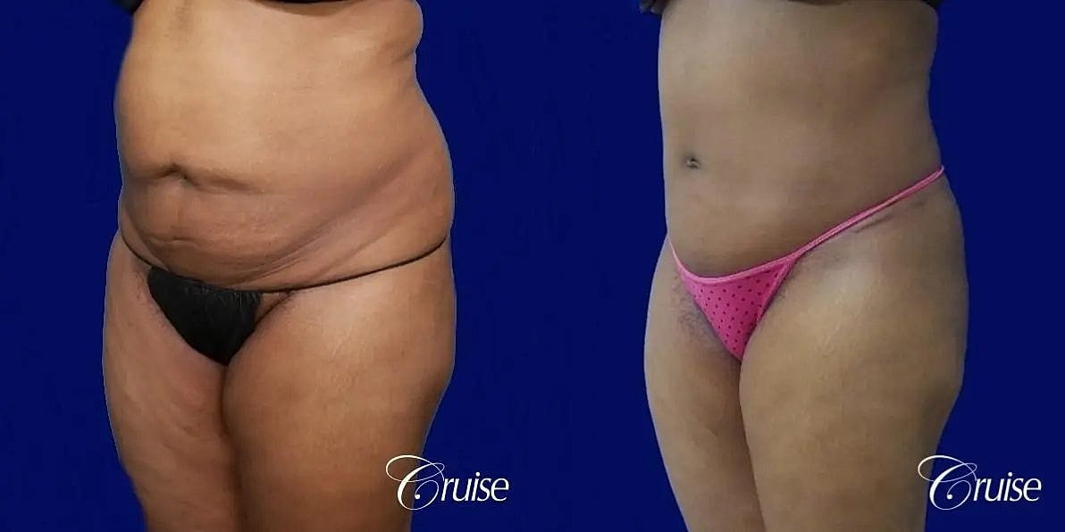 Tummy Tuck Before & After
