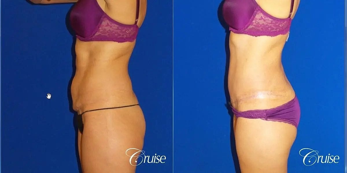 Tummy Tuck Before & After
