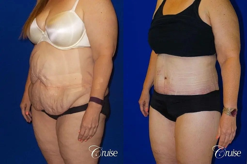 Tummy Tuck Before & After