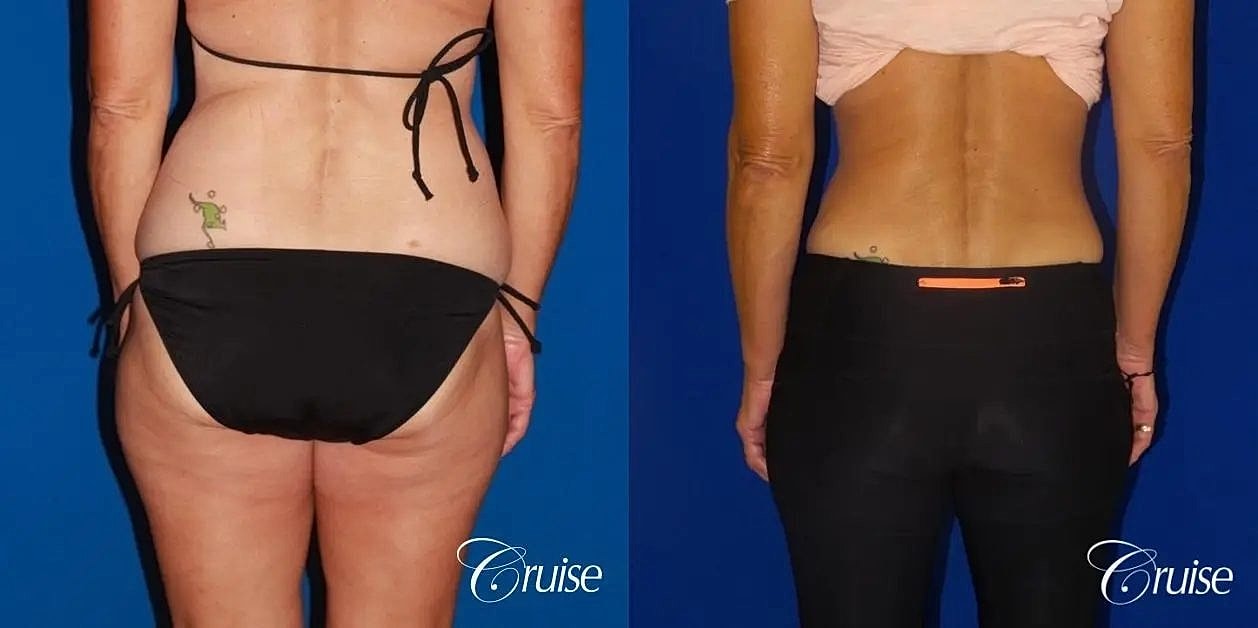 Tummy Tuck Before & After