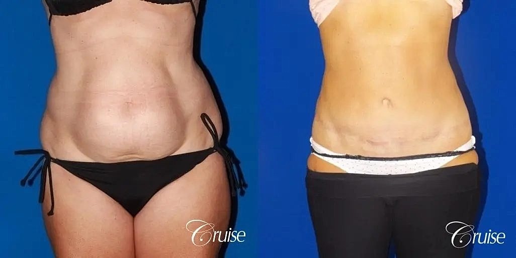 Tummy Tuck Before & After