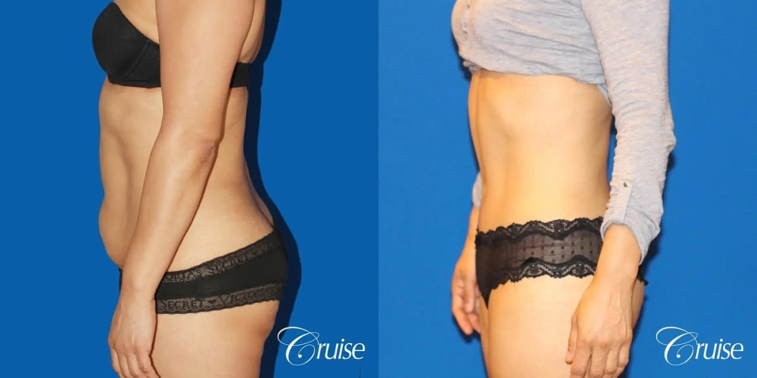 Tummy Tuck Before & After