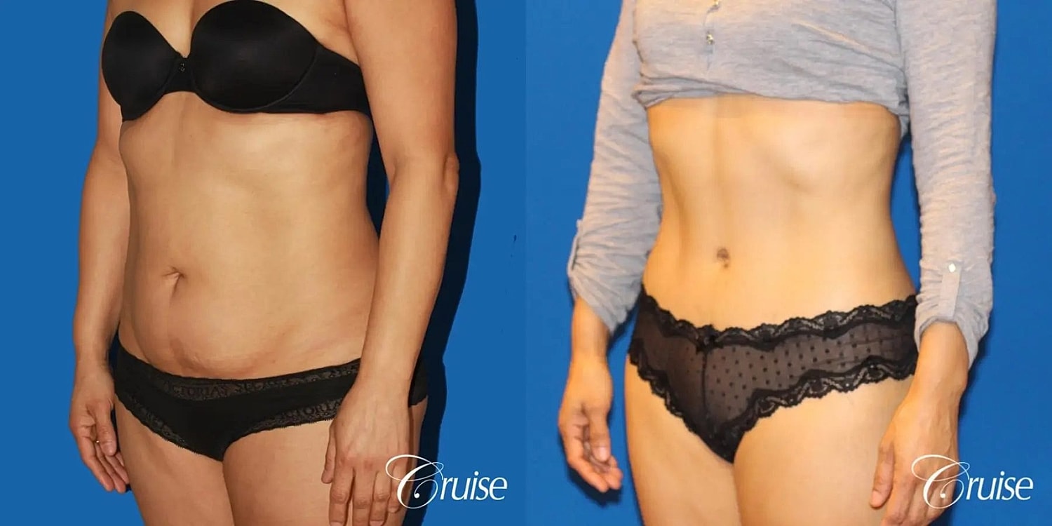 Tummy Tuck Before & After