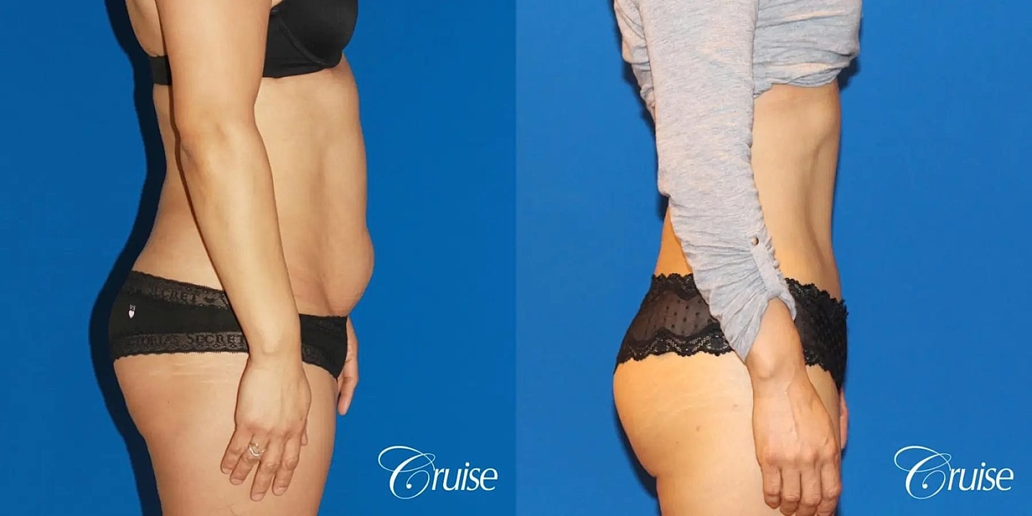 Tummy Tuck Before & After
