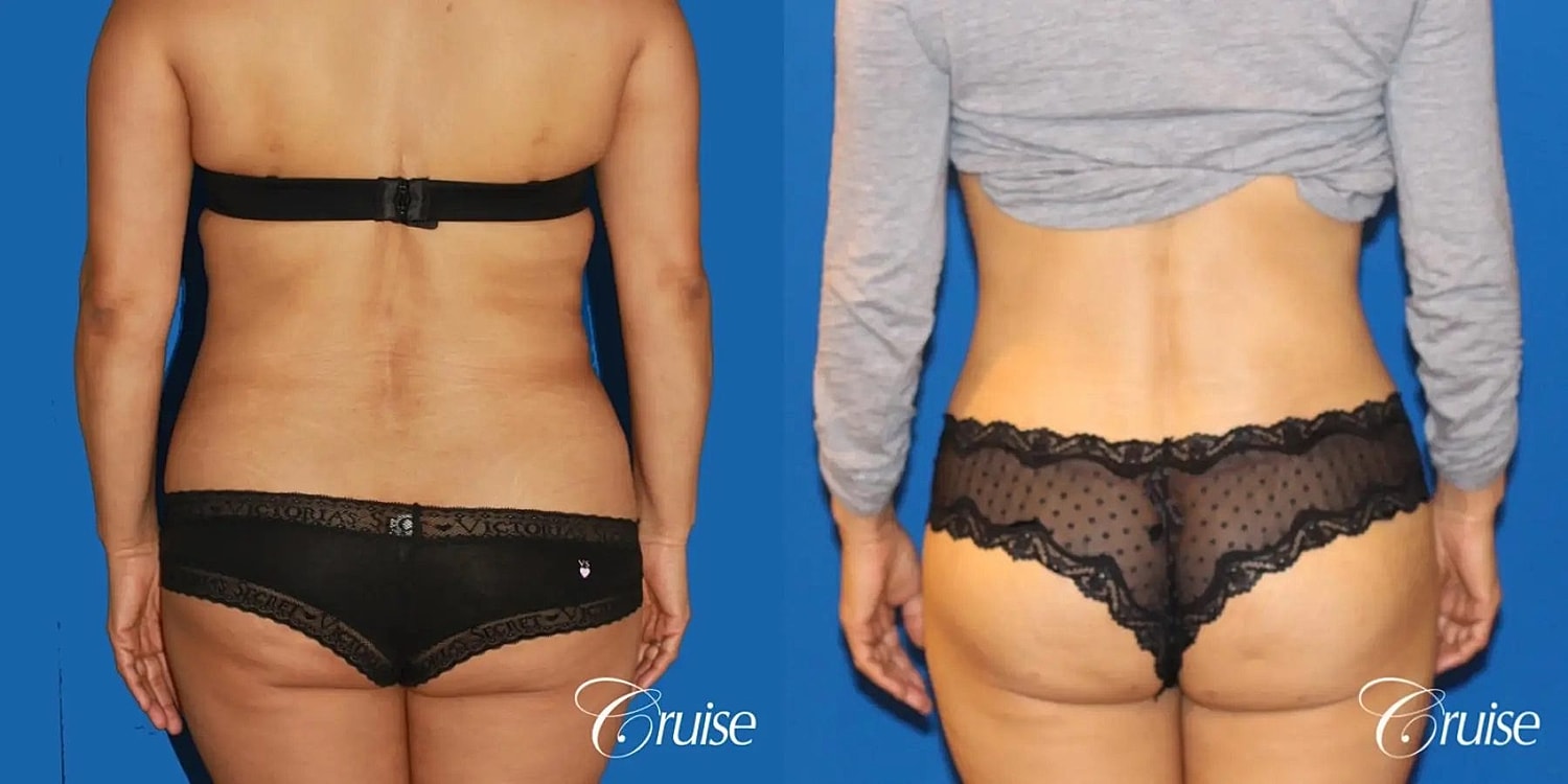 Tummy Tuck Before & After