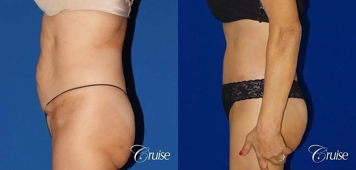 Tummy Tuck Before & After