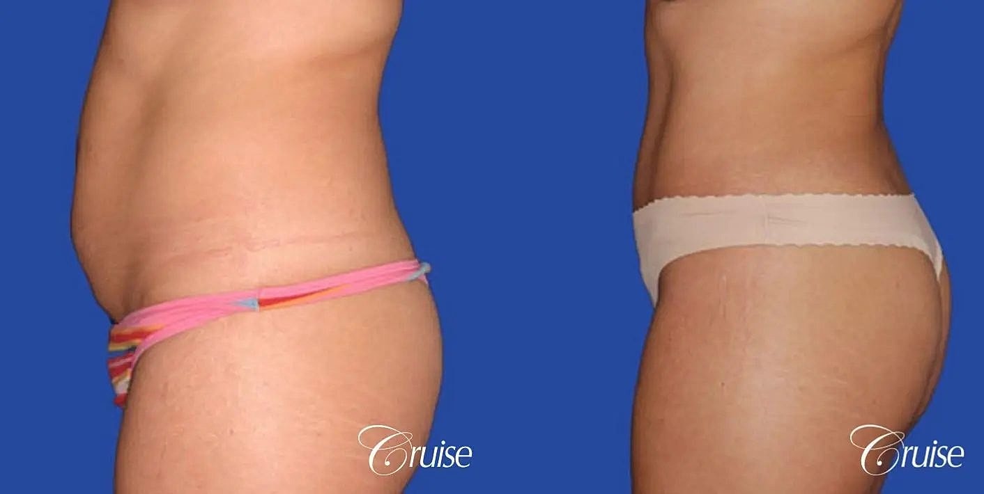 Tummy Tuck Before & After