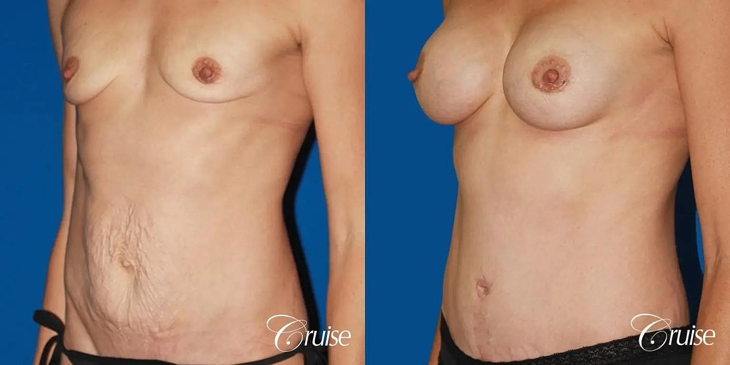 Tummy Tuck Before & After