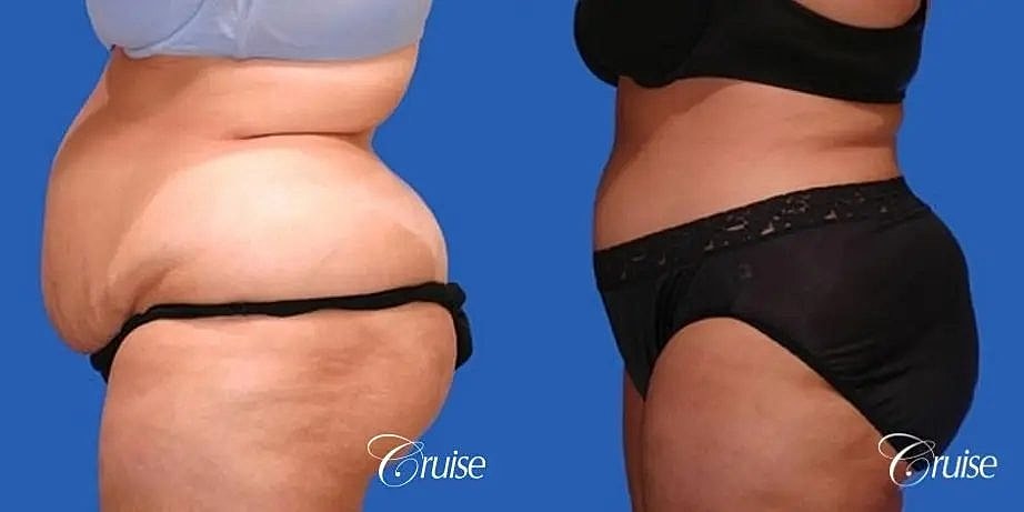 Tummy Tuck Before & After