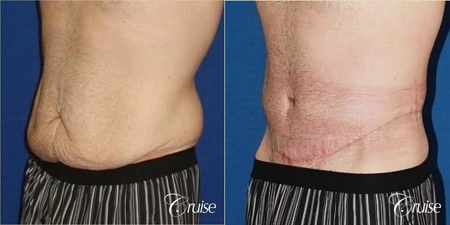 Tummy Tuck Before & After