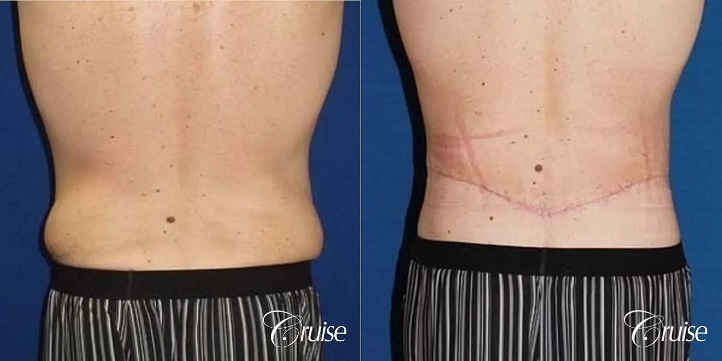 Tummy Tuck Before & After