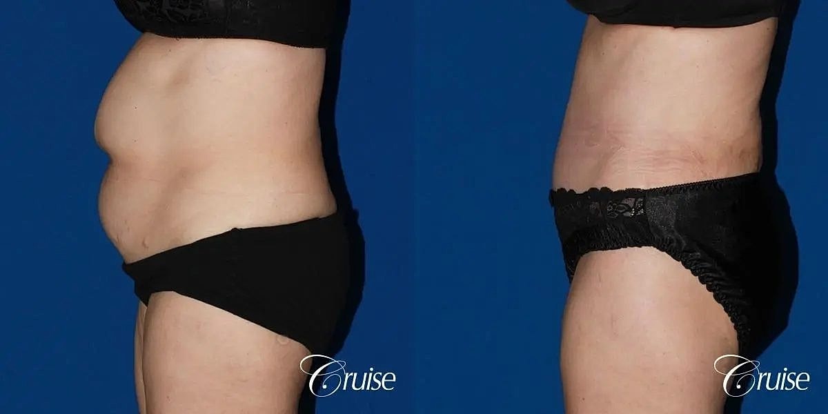 Tummy Tuck Before & After