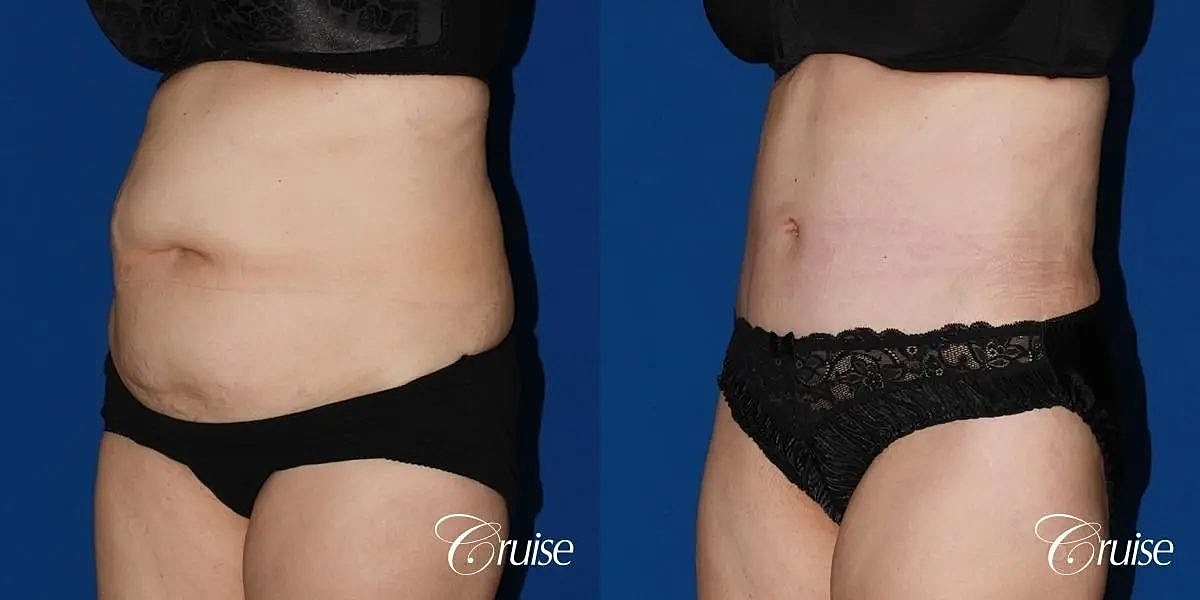 Tummy Tuck Before & After