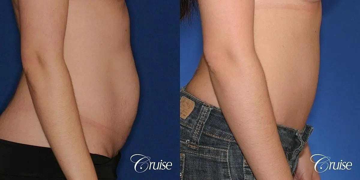 Tummy Tuck Before & After