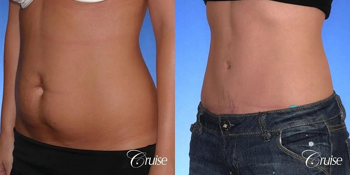 Tummy Tuck Before & After