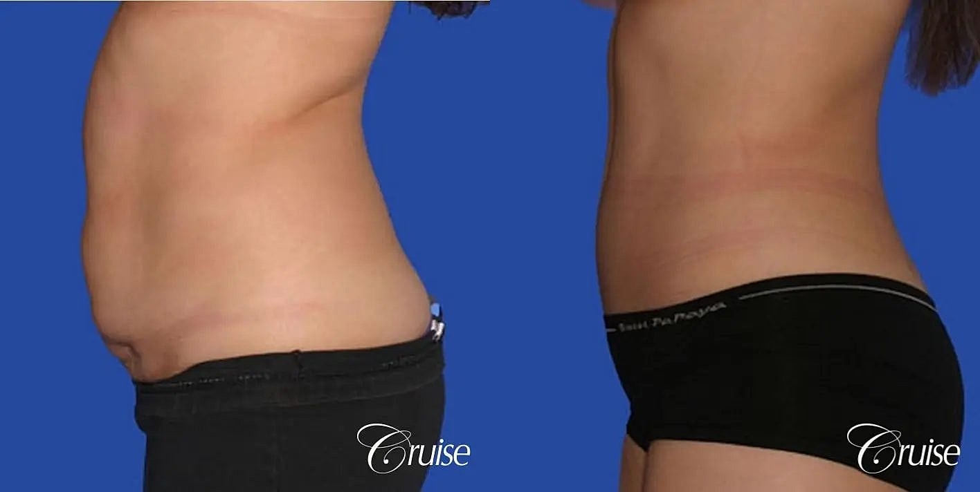 Tummy Tuck Before & After