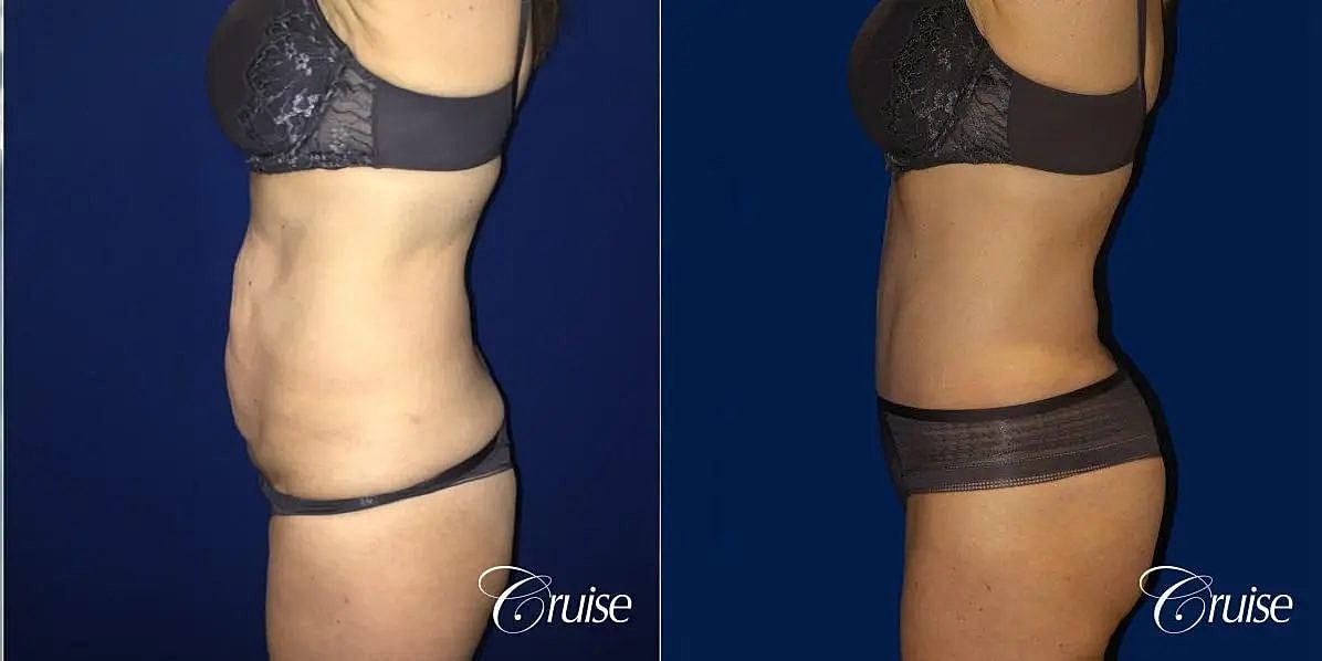 Tummy Tuck Before & After
