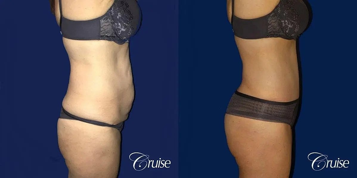 Tummy Tuck Before & After