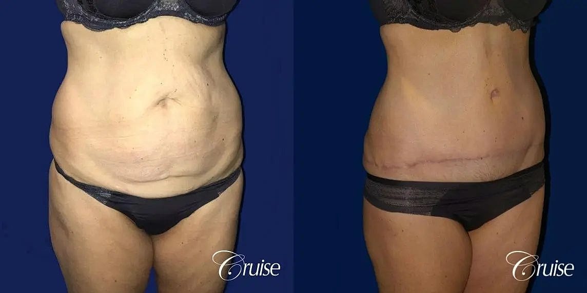 Tummy Tuck Before & After