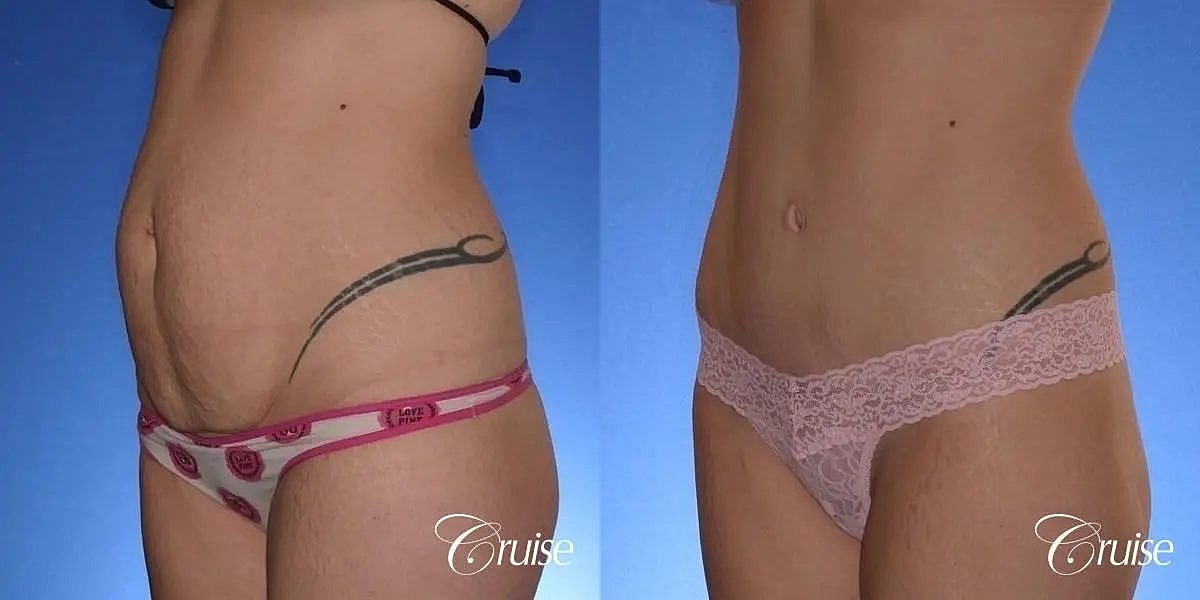 Tummy Tuck Before & After