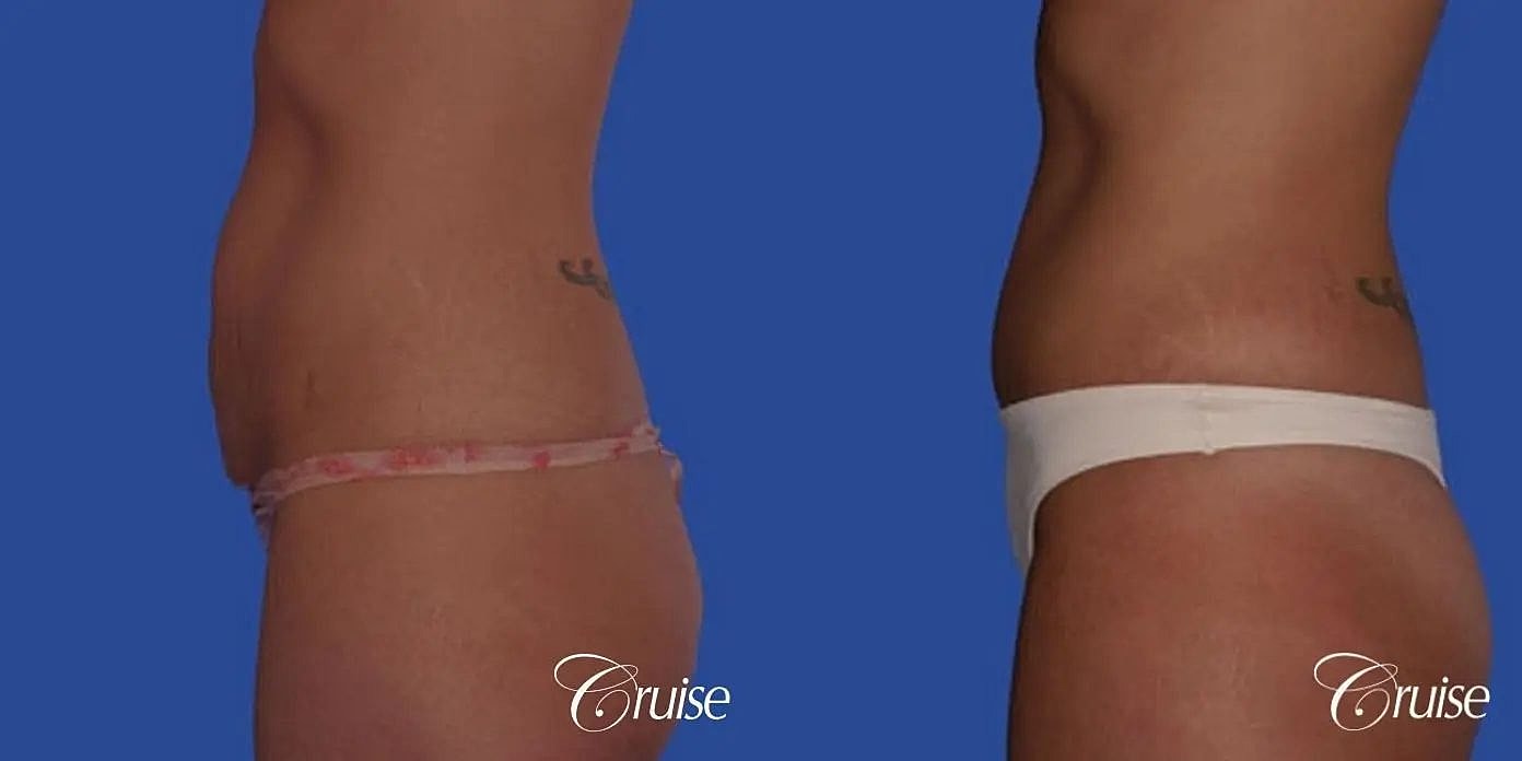 Tummy Tuck Before & After