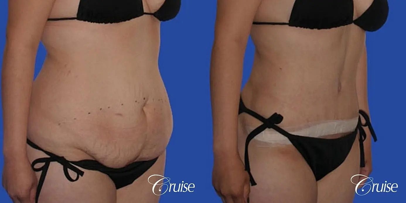 Tummy Tuck Before & After