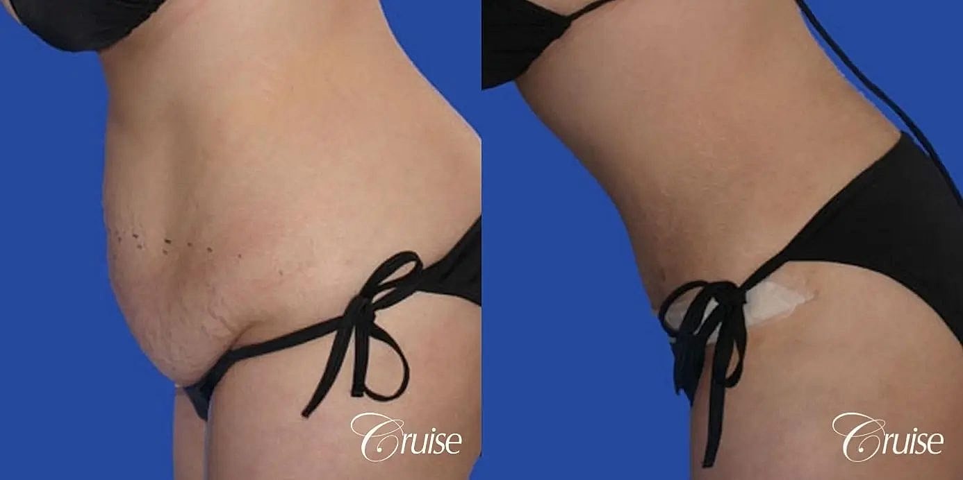 Tummy Tuck Before & After