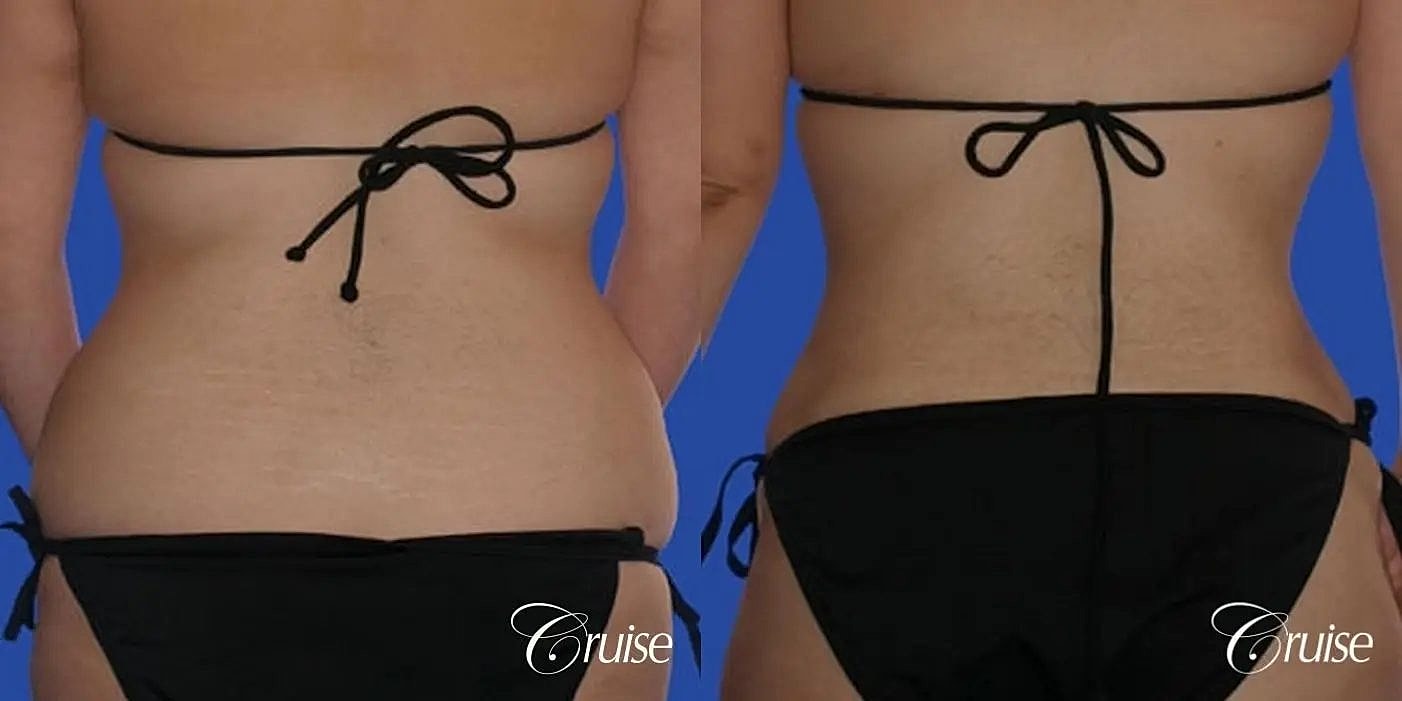 Tummy Tuck Before & After