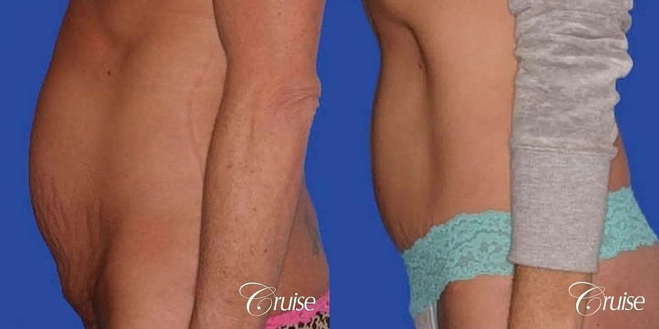 Tummy Tuck Before & After