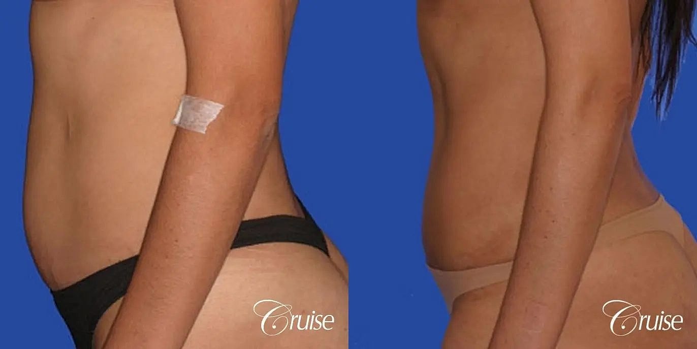 Tummy Tuck Before & After