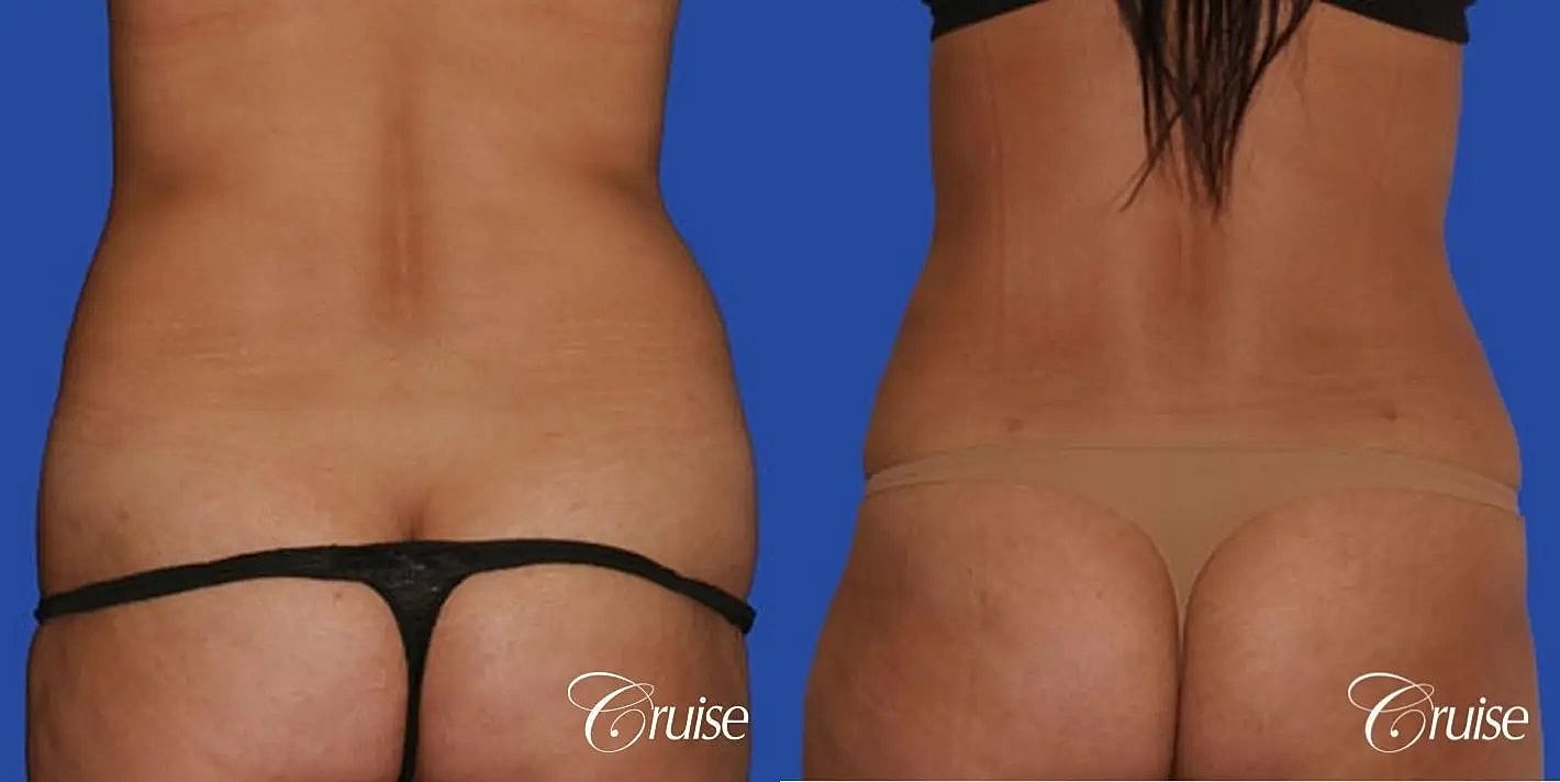 Tummy Tuck Before & After