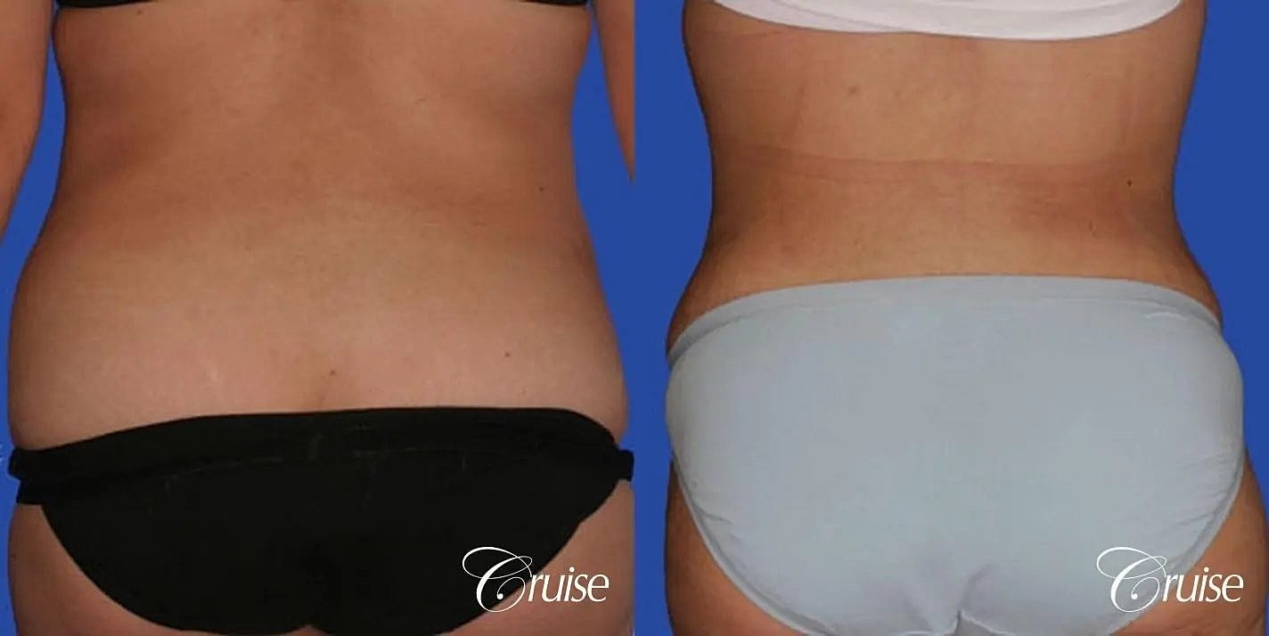 Tummy Tuck Before & After