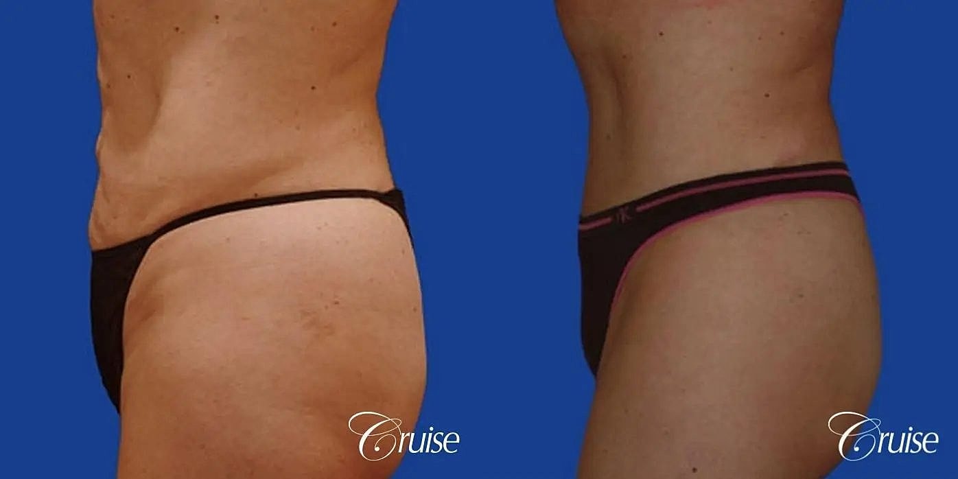 Tummy Tuck Before & After